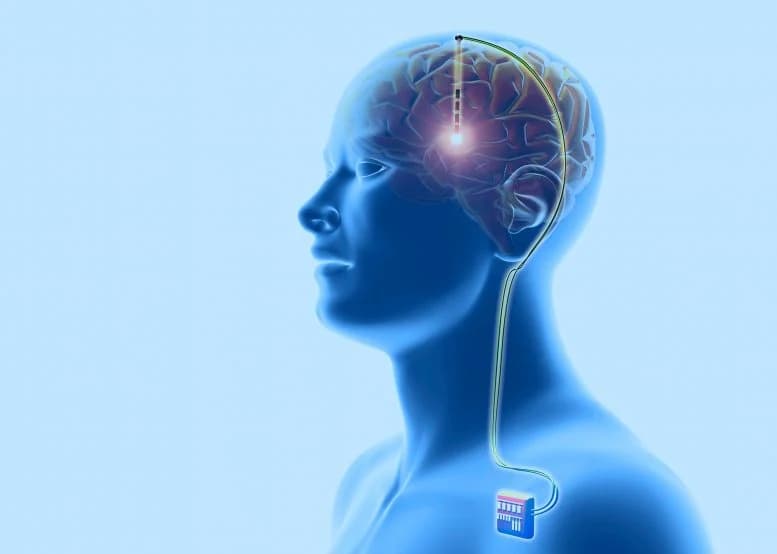 How Much Does Deep Brain Stimulation Cost? Country-by-Country Comparison (2026)