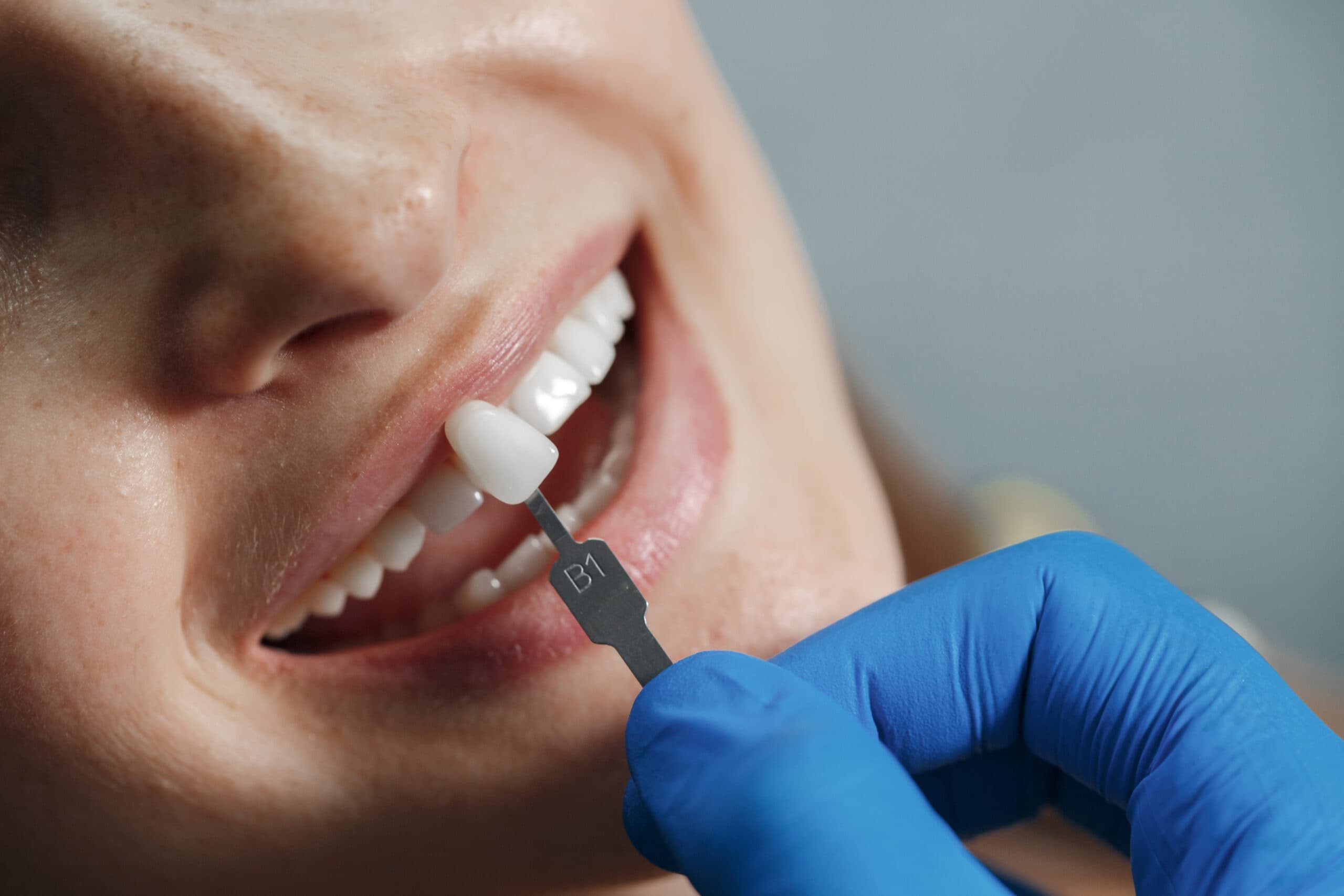 Zirconia Crowns in Turkey